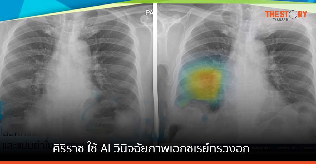 ศิริราช ใช้ AI วินิจฉัยภาพเอกซเรย์ทรวงอก เพื่อความถูกต้องและแม่นยำ