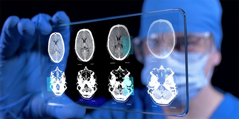 ภาพ CT และ MRI โรค หลอดเลือดสมอง (Stroke)